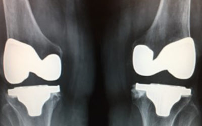 Recording: Arthritis Awareness Month – Knee and Hip Joint Replacement